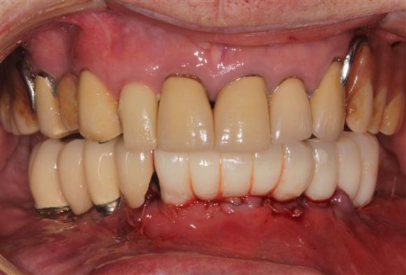Surgical and Non- surgical tooth replacement