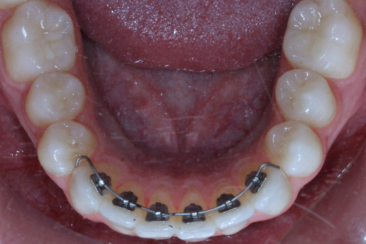 Lingual Braces. Services provide in Lucknow